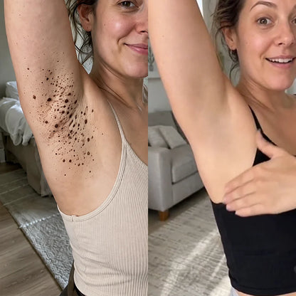 Natravor® 7-𝐃𝐚𝐲 𝐒𝐤𝐢𝐧 𝐓𝐚𝐠 & 𝐒𝐩𝐨𝐭 𝐄𝐫𝐚𝐬𝐞𝐫 𝐂𝐫𝐞𝐚𝐦 (Zero Pain, Zero 𝐒𝐜𝐚𝐫𝐬 Formula) 💎