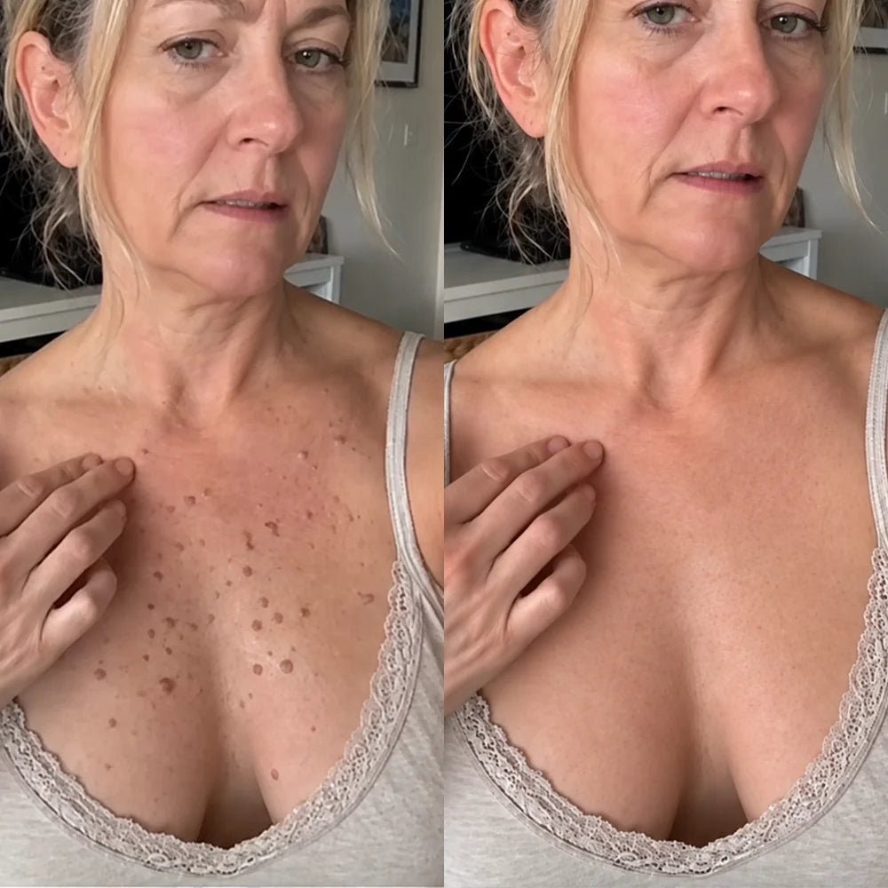 Natravor® 7-𝐃𝐚𝐲 𝐒𝐤𝐢𝐧 𝐓𝐚𝐠 & 𝐒𝐩𝐨𝐭 𝐄𝐫𝐚𝐬𝐞𝐫 𝐂𝐫𝐞𝐚𝐦 (Zero Pain, Zero 𝐒𝐜𝐚𝐫𝐬 Formula) 💎